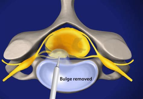 Micro Discectomy Surgery: Minimally Invasive Back Pain Relief
