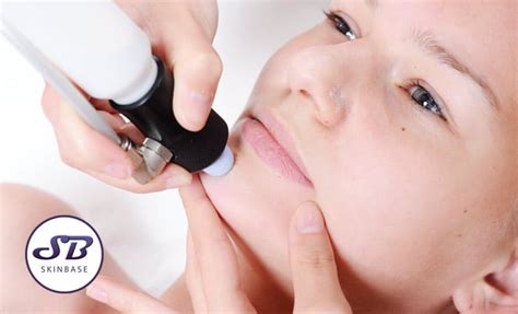 Microdermabrasion Hurt