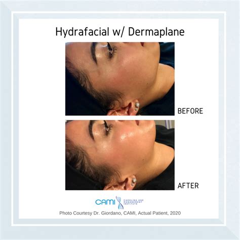 Microdermabrasion Vs Hydrafacial