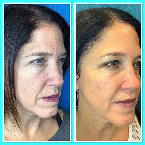 MICRONEEDLING & CHEMICAL PEEL EXPERIENCE AFTER CARE BEFORE & AFTER