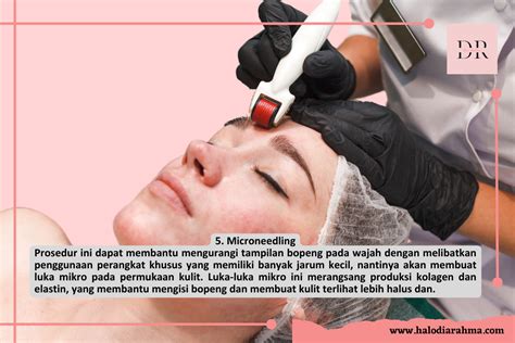 Microneedling untuk bekas jerawat