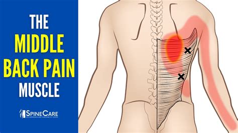 Middle Back Pain From Lifting
