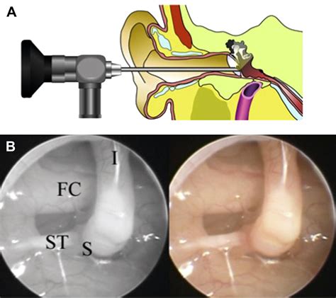 Middle Ear Endoscopy Test