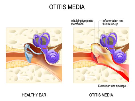 Understanding Middle Ear Fluid: Causes, Symptoms, and Effective Treatment Options