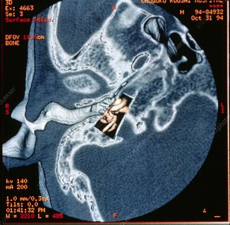 middle ear on ct