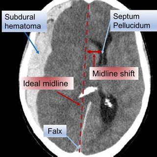 Midline Shift Vs Normal