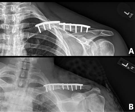 Midshaft Collarbone Fracture