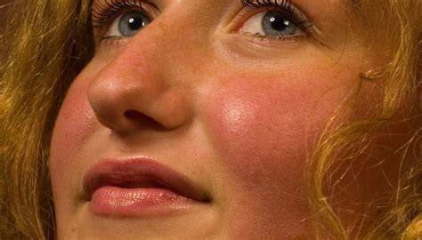 Mild Headache And Flushed Face