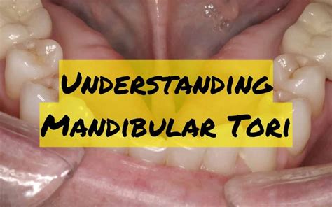 mild mandibular tori