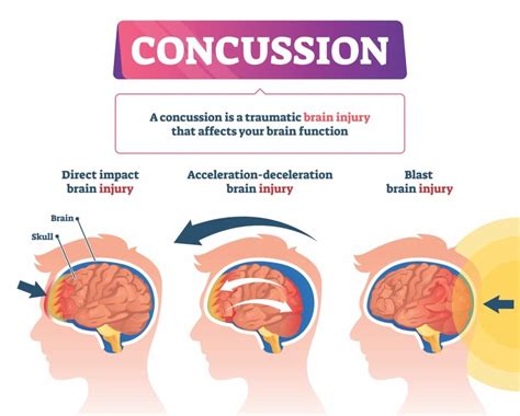 mild traumatic brain injury vs concussion