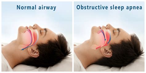 mild vs moderate sleep apnea