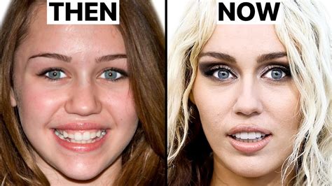 miley cyrus face surgery