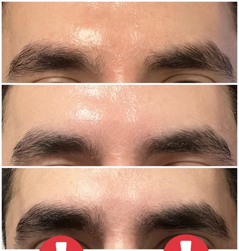minoxidil and eyebrows