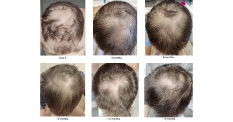 minoxidil long term study 1