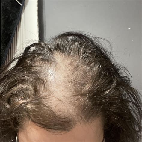 Minoxidil Side Effects Reddit