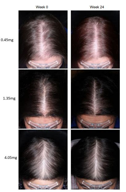 Minoxidil Systemic Effects