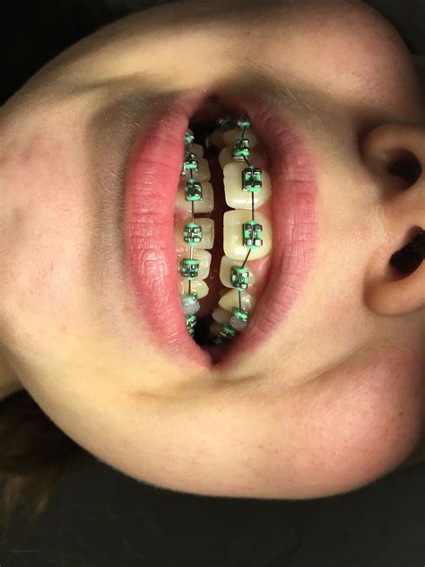 Mint Green Color Braces