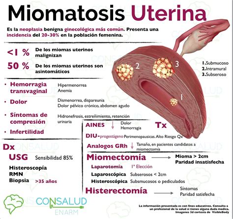 miomatosis adenomiosis y endometriosis
