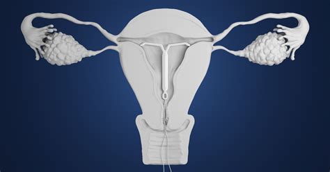 mirena iud coming out