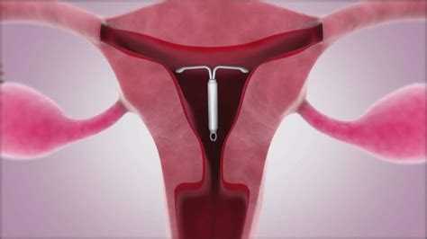 mirena iud for pcos