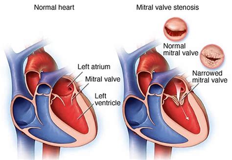 mitral valve stenosis numbers