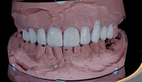 Modelos De Diagnostico Dental Diagnóstico En Ortodoncia Clínica ntal En Tegucigalpa