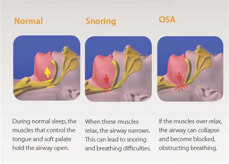 moderate obstructive sleep apnoea