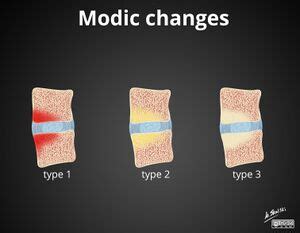 modic type 2 endplate changes