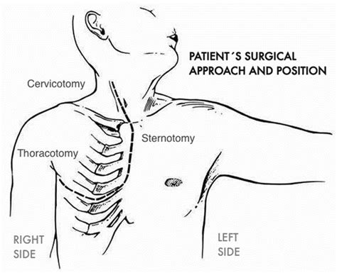 Modified Clamshell Thoracotomy