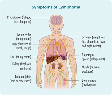 Modular Zone Lymphoma