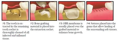 molar extraction bone graft
