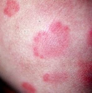 mold cause hives