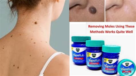 mole removal at home