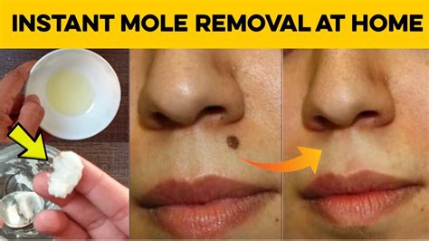 mole removal at home reddit