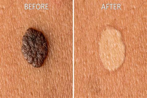 mole removal at home scars