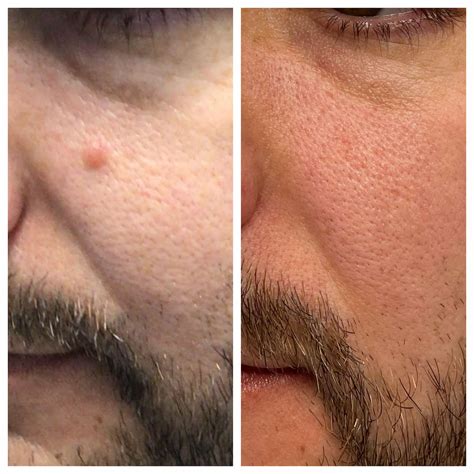 mole removal dermatologist near me