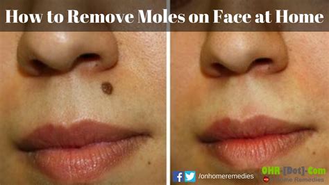 mole removal face natural