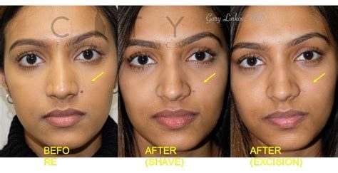 mole removal face plastic surgeon