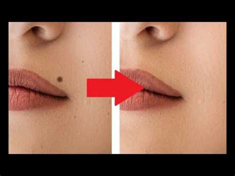 mole removal face without scarring