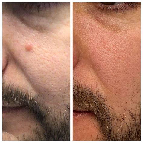 mole removal near me skin