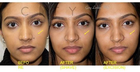 mole removal plastic surgeon