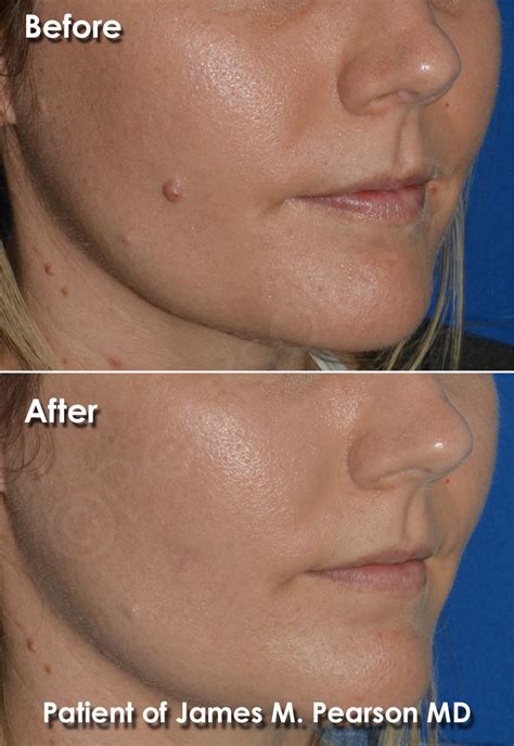 mole removal procedure on face