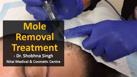 mole removal surgery cpt