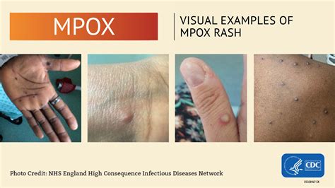 monkey pox rash photos
