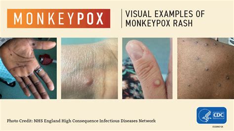 monkey pox rash symptoms