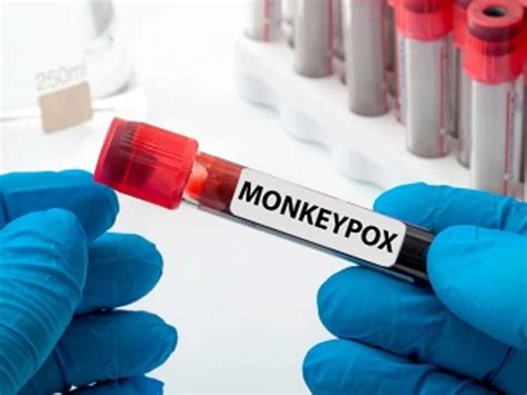 monkeypox cases in canada
