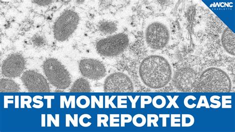 monkeypox cases in nc