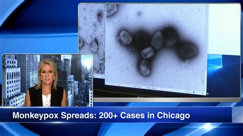 monkeypox chicago cases