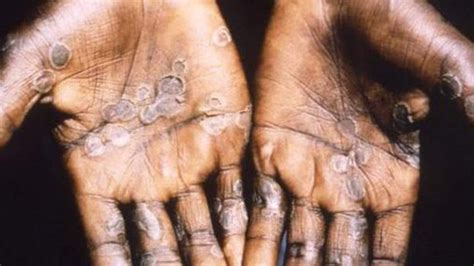 monkeypox outbreak 2020 nigeria
