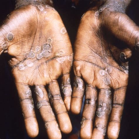 monkeypox outbreak in nigeria 2022